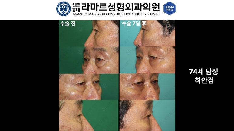 30대~80대 눈 수술 케이스 : 하안검성형술 전후 사진 모음 관련 이미지 36