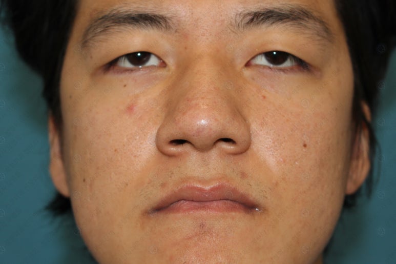27세 남성 무쌍(속쌍)눈매교정 (27/M Ptosis correction with double lid plasty) 관련 이미지 5