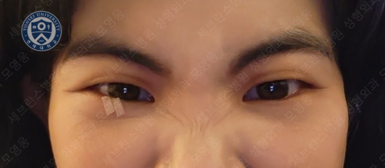 28세 여성, 눈밑지방재배치(눈밑지, 28/F Transconjunctival septal fat redraping-internal fixation technique) 관련 이미지 17