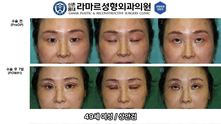 40대~80대 눈 수술 케이스 : 상안검성형술 전후 사진 모음 관련 이미지 10