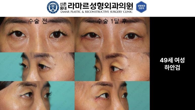 30대~80대 눈 수술 케이스 : 하안검성형술 전후 사진 모음 관련 이미지 38