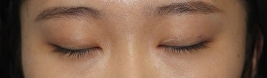 17세 여성, 쌍꺼풀+앞트임(DEO+Medial epicanthoplasty) 관련 이미지 45