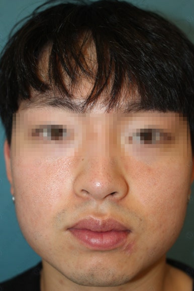 개에 물려 입술 1/3이 뜯긴 19세 남자분 치료 및 흉터 성형수술& 레이저 후기....! 관련 이미지 57