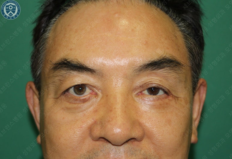 68세 남성, 하안검 성형술 및 안검외반 교정 증례(68/M Lower blepharoplasty & Ectropion correction with triamcinolone) 관련 이미지 6