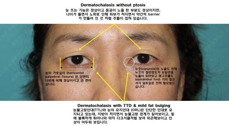 55세 여성, 상안검 및 하안검 성형술 증례 (55/F Upper & lower blepharoplasty) 관련 이미지 9