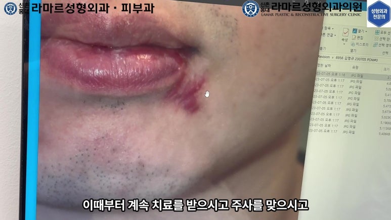개에 물려 입술 1/3이 뜯긴 19세 남자분 치료 및 흉터 성형수술& 레이저 후기....! 관련 이미지 44