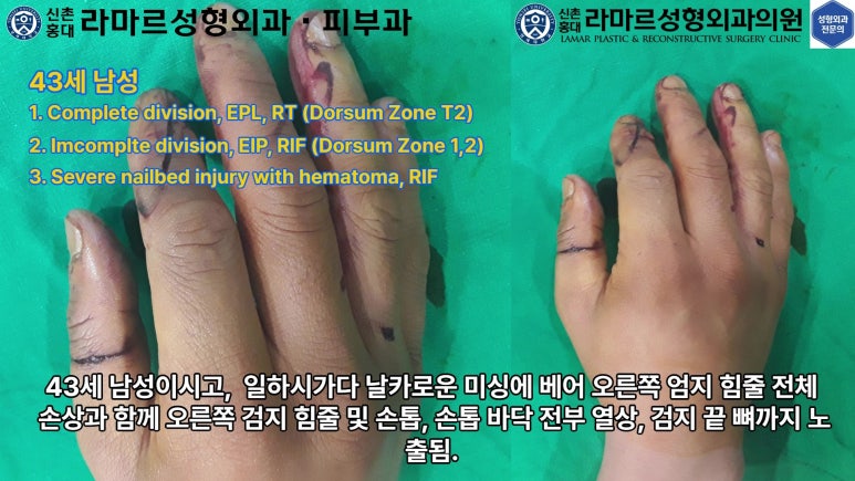손가락 힘줄 손상 및 열상, 손톱 바닥 열상 처치 (Extensor tendon repair and nailbed injury treatment) 관련 이미지 10