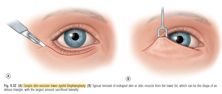 38세 서양 백인 여성, 쌍꺼풀 수술과 눈매교정 및 하안검성형술 (38/F Upper&lower blepharoplasty with levator plication) 관련 이미지 11