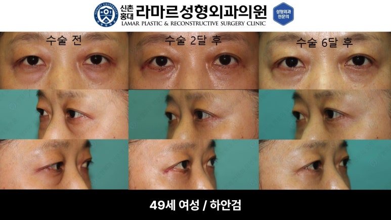 30대~80대 눈 수술 케이스 : 하안검성형술 전후 사진 모음 관련 이미지 46