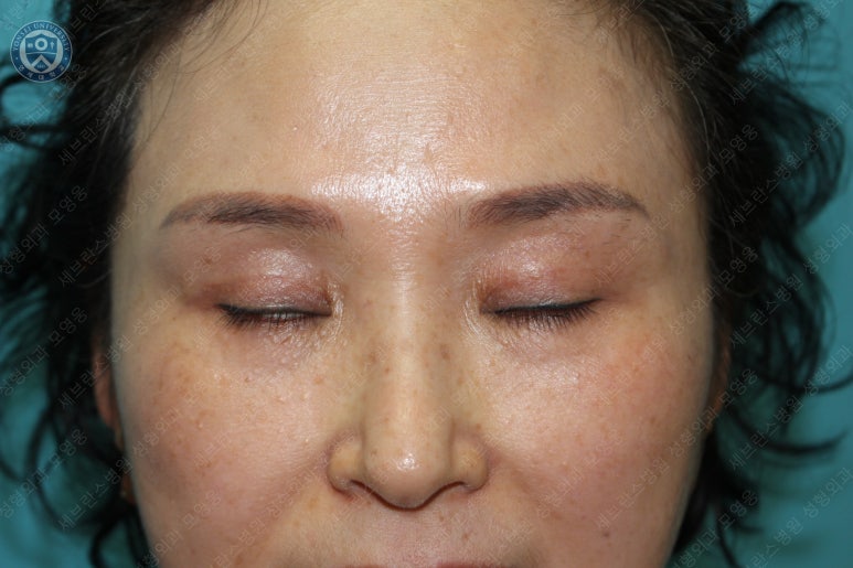 49세 여성, 토안이 있는 중년여성의 상안검성형술 (49/F, Upper blepharoplasty with lagophthalmos correction& LP) 관련 이미지 34