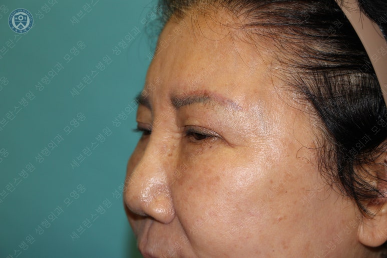 71세 여성, 이마거상술과 이마축소술 (71/F, Forehead lift and reduction) 관련 이미지 7