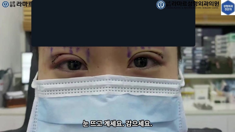 매몰 쌍꺼풀 풀고 절개쌍꺼풀로 바꾸는 쌍꺼풀 재수술!! 관련 이미지 46
