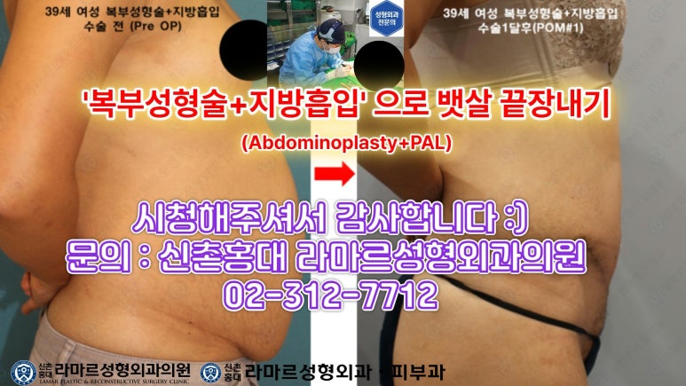 '복부성형술+지방흡입(Abdominoplasty+PAL)' 으로 뱃살 끝장내기! 관련 이미지 66