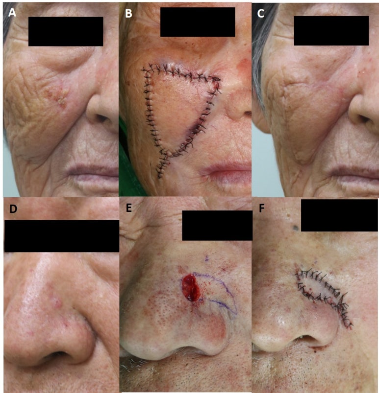 Medicine - Comparison of the recurrence rate of 3 treatmentmodalities for BD in an aging city 관련 이미지 10