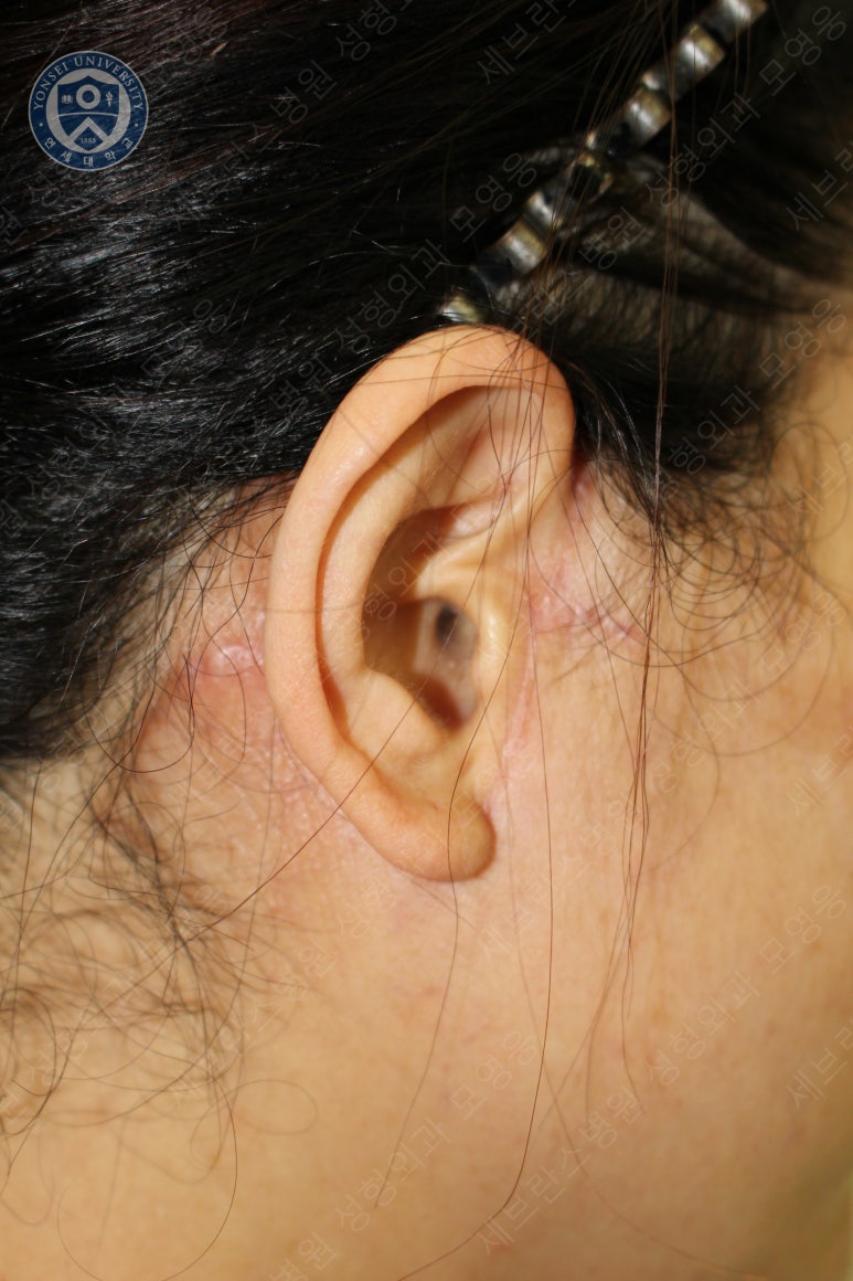 55세 여성, 이중평면 안면거상(55/F, Dual-plane full facelift) 관련 이미지 59