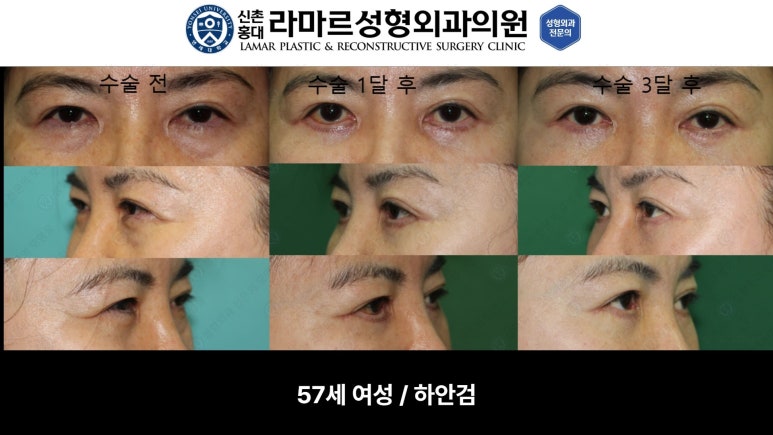 30대~80대 눈 수술 케이스 : 하안검성형술 전후 사진 모음 관련 이미지 37