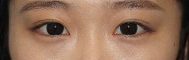 17세 여성, 쌍꺼풀+앞트임(DEO+Medial epicanthoplasty) 관련 이미지 44