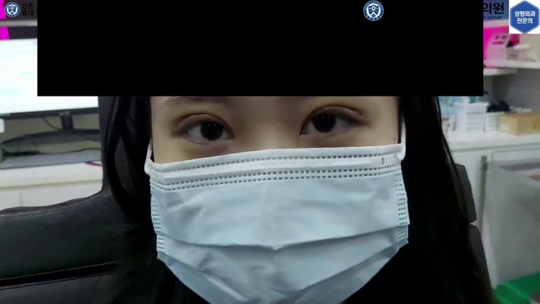 매몰 쌍꺼풀 풀고 절개쌍꺼풀로 바꾸는 쌍꺼풀 재수술!! 관련 이미지 55
