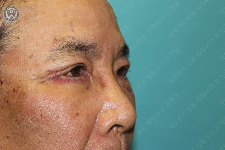 67세 남성, 상&middot;하안검성형술 및 안검하수교정 (67/M, Upper &  lower blepharoplasty with ptosis correction) 관련 이미지 26