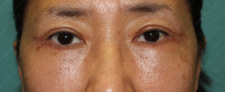 55세 여성, 상안검 및 하안검 성형술 증례 (55/F Upper & lower blepharoplasty) 관련 이미지 13