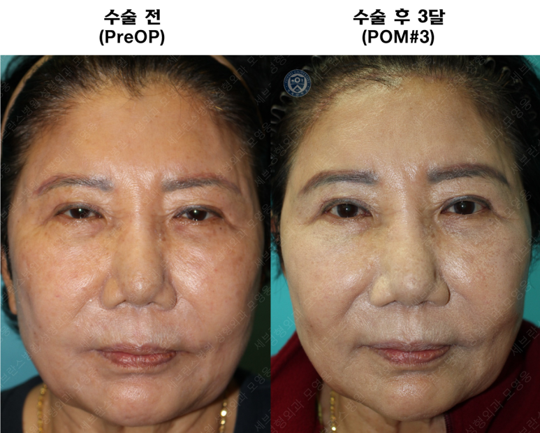 71세 여성, 이마거상술과 이마축소술 (71/F, Forehead lift and reduction) 관련 이미지 52