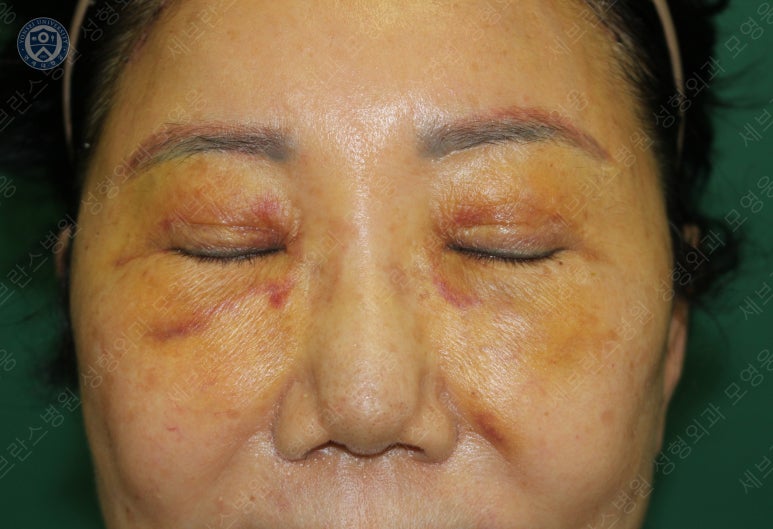 71세 여성, 이마거상술과 이마축소술 (71/F, Forehead lift and reduction) 관련 이미지 22