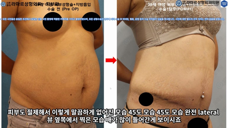 '복부성형술+지방흡입(Abdominoplasty+PAL)' 으로 뱃살 끝장내기! 관련 이미지 54