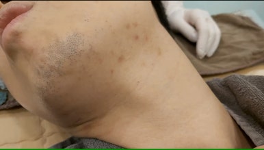 모영웅 대표원장 해초필링(FCR peeling) 피부관리영상...! 멍게피부가 사과피부가 되는 과정을 보여드립니다^^ 관련 이미지 44