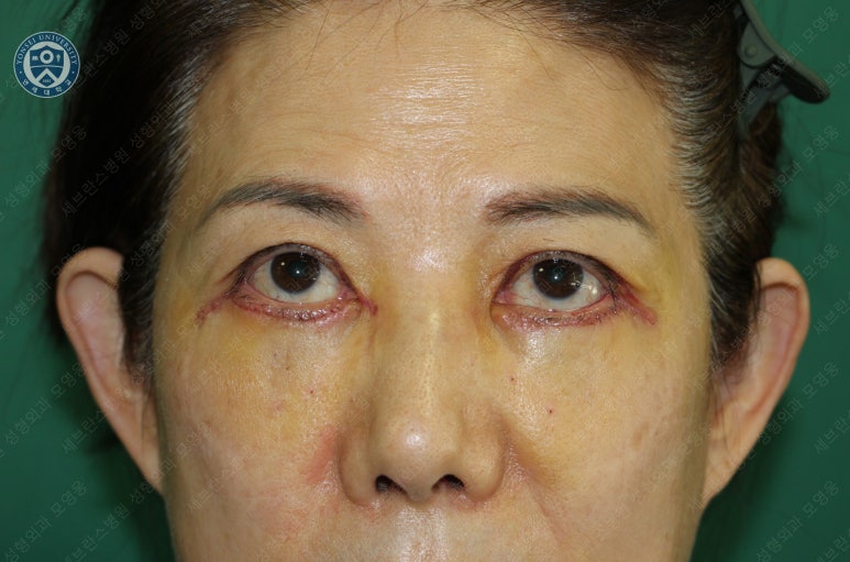 59세 여성, 그레이브스 안병증이 있는 돌출눈 중년 여성 하안검 성형술 (Lower blepharoplasty in Graves 관련 이미지 12