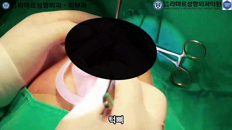 파라핀 필러 입 안 절개로 흉터없이 빼내기! 관련 이미지 71