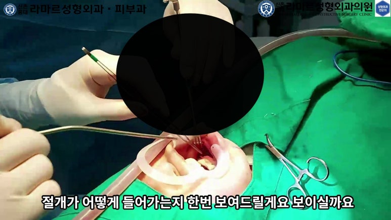파라핀 필러 입 안 절개로 흉터없이 빼내기! 관련 이미지 24