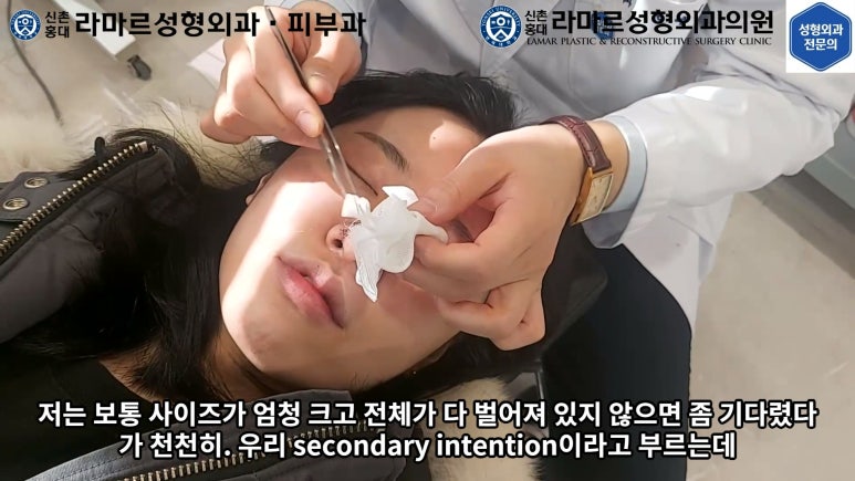 지름 1cm 코 점 제거수술 : 나선피판술(Spiral Flap) 수술전~1달 경과. (Feat. 턱끝필러+사각턱 보톡스) 관련 이미지 69