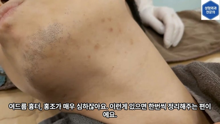 모영웅 대표원장 해초필링(FCR peeling) 피부관리영상...! 멍게피부가 사과피부가 되는 과정을 보여드립니다^^ 관련 이미지 20