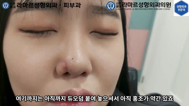 지름 1cm 코 점 제거수술 : 나선피판술(Spiral Flap) 수술전~1달 경과. (Feat. 턱끝필러+사각턱 보톡스) 관련 이미지 153