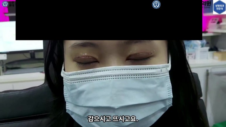 매몰 쌍꺼풀 풀고 절개쌍꺼풀로 바꾸는 쌍꺼풀 재수술!! 관련 이미지 56