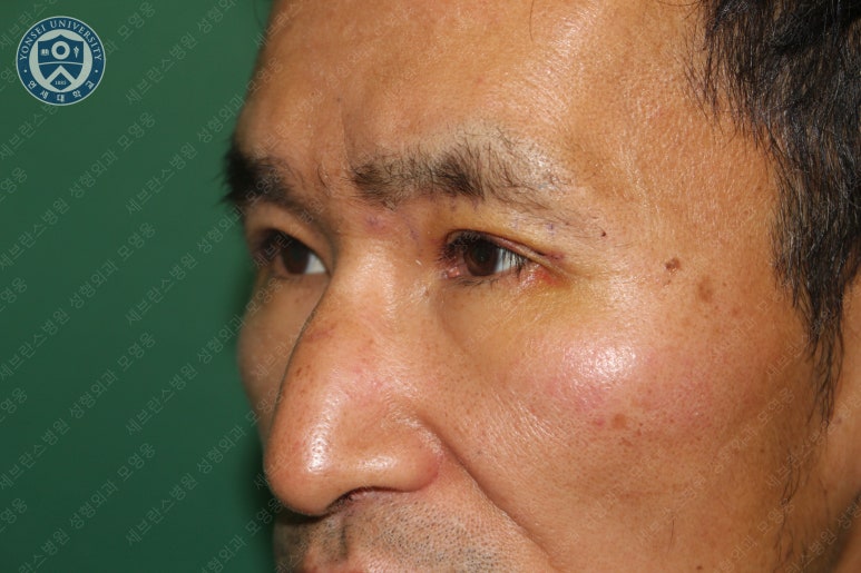 남자눈성형: 무쌍눈매교정 (Blephroptosis correction-levator aponeurosis advancement) 관련 이미지 26