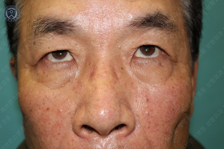 67세 남성, 상&middot;하안검성형술 및 안검하수교정 (67/M, Upper &  lower blepharoplasty with ptosis correction) 관련 이미지 10
