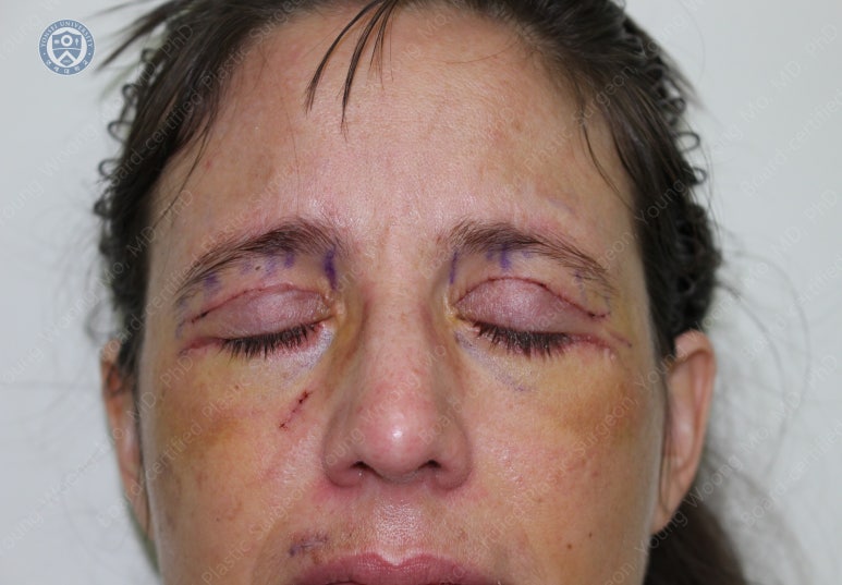 38세 서양 백인 여성, 쌍꺼풀 수술과 눈매교정 및 하안검성형술 (38/F Upper&lower blepharoplasty with levator plication) 관련 이미지 14