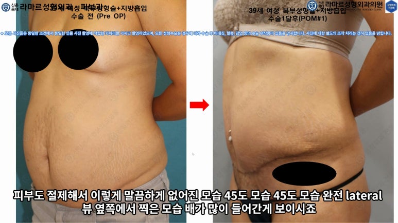 '복부성형술+지방흡입(Abdominoplasty+PAL)' 으로 뱃살 끝장내기! 관련 이미지 53