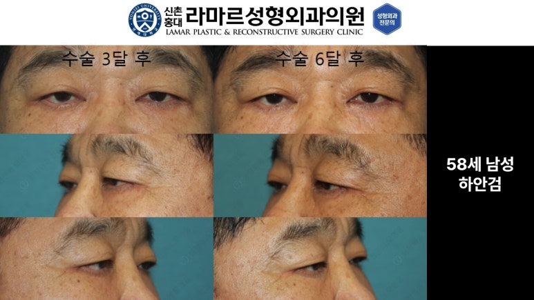 30대~80대 눈 수술 케이스 : 하안검성형술 전후 사진 모음 관련 이미지 12
