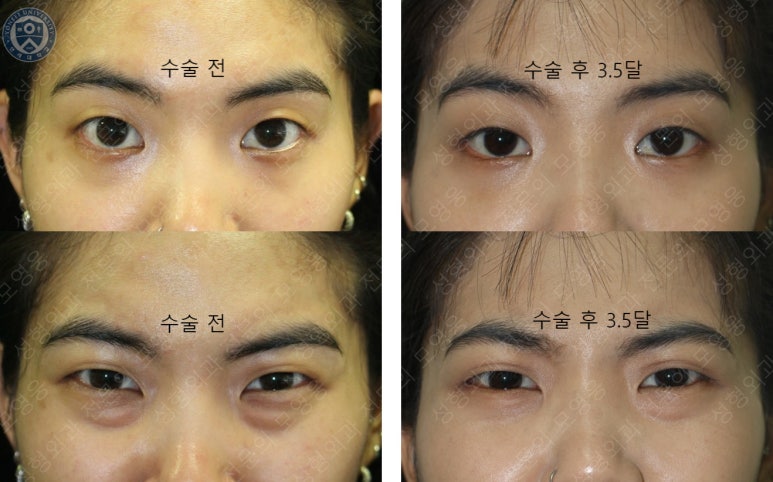 28세 여성, 눈밑지방재배치(눈밑지, 28/F Transconjunctival septal fat redraping-internal fixation technique) 관련 이미지 29