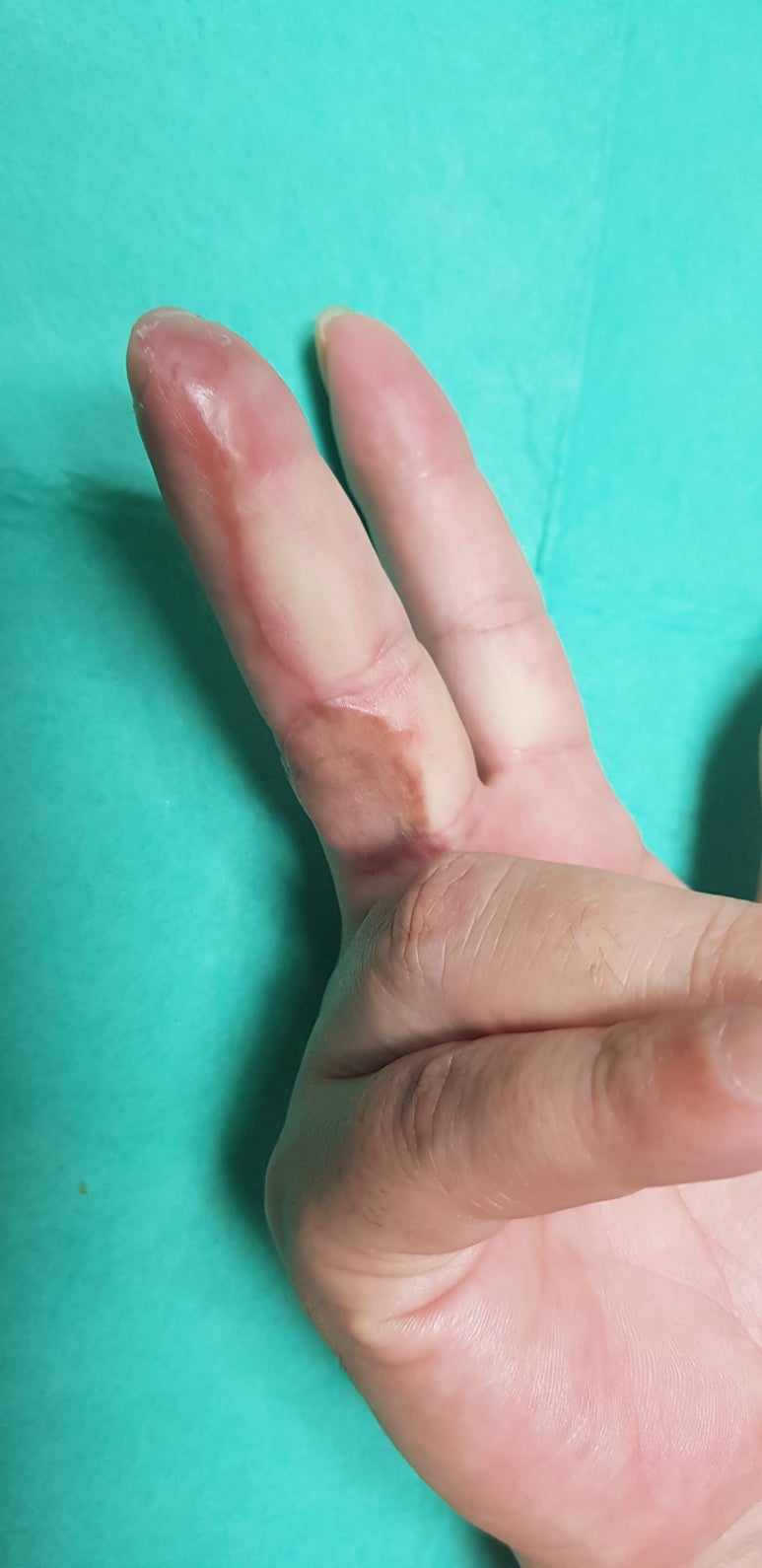 수지 말단부 절단에 시행한 동측 역행성 유경피판술 증례 (Homodigital Reverse Island Flap for Fingertip Amputation) 관련 이미지 14