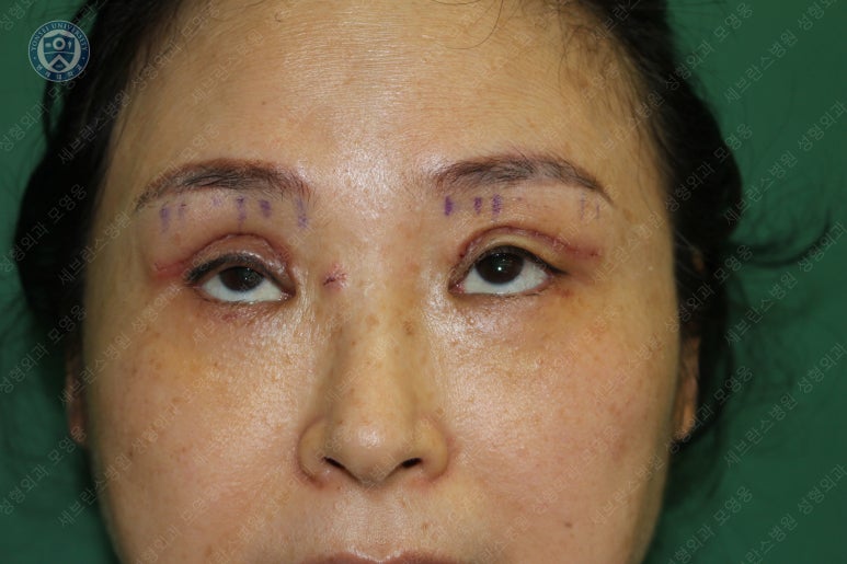 49세 여성, 토안이 있는 중년여성의 상안검성형술 (49/F, Upper blepharoplasty with lagophthalmos correction& LP) 관련 이미지 19