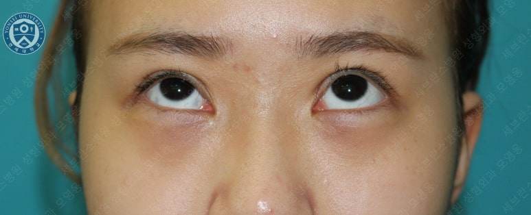 17세 여성, 비절개 눈매교정 및 앞트임 재수술 (17/F NI ptosis correction & Med. epicanthoplasty revision) 증례 관련 이미지 13
