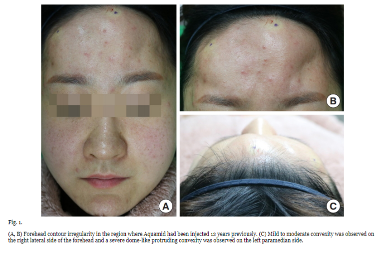 AAPS-Polyacrylamide hydrogel (Aquamid) filler removal after a decade 관련 이미지 3