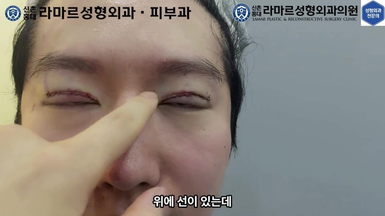29세 남자, 소시지 쌍꺼풀 두줄따기로 낮추기 (쌍꺼풀 재수술) 관련 이미지 62