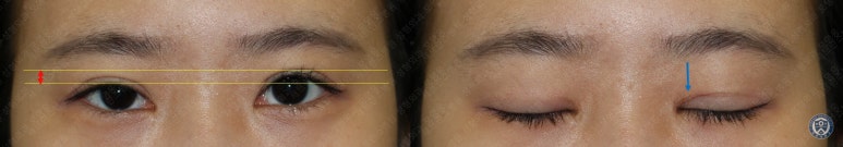17세 여성, 비절개 눈매교정 및 앞트임 재수술 (17/F NI ptosis correction & Med. epicanthoplasty revision) 증례 관련 이미지 7