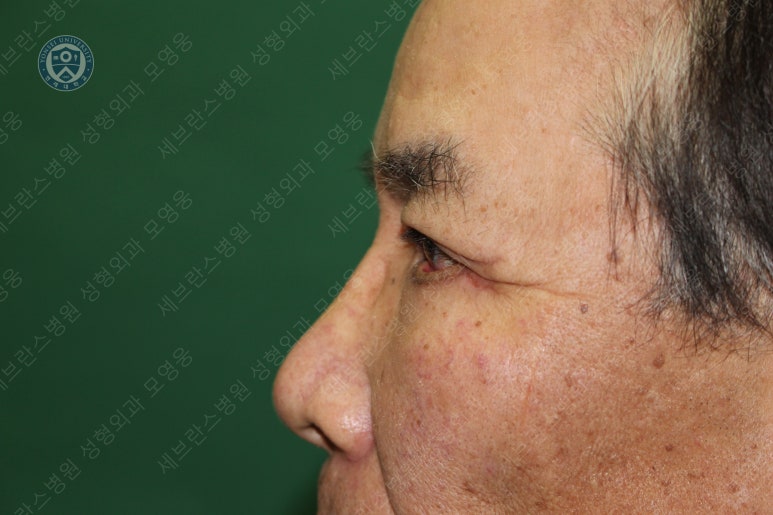 67세 남성, 상&middot;하안검성형술 및 안검하수교정 (67/M, Upper &  lower blepharoplasty with ptosis correction) 관련 이미지 32