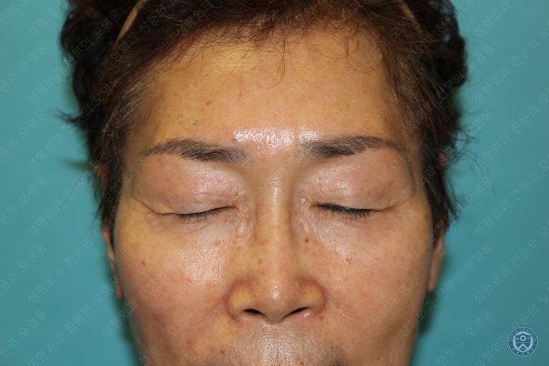 64세 여성 상안검성형술+눈매교정 (64/F Upper blepharoplasty with ptosis correction) 관련 이미지 4