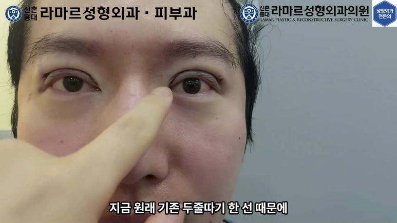 29세 남자, 소시지 쌍꺼풀 두줄따기로 낮추기 (쌍꺼풀 재수술) 관련 이미지 57
